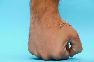 fermer de une main blessure avec des points de suture photo