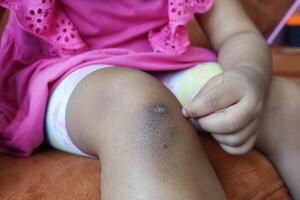 tache bleu blessure sur enfant genou. photo