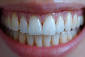 ai généré magnifique large sourire de une Jeune Frais femme avec blanc en bonne santé les dents photo