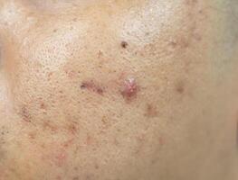 peau problèmes. problème de enflammé acné sur le affronter. enflammé acné consiste de gonflement, rougeur, et les pores cette sont gravement bouché avec bactéries, huile, et mort peau cellules. photo