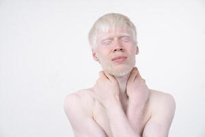 albinisme albinos homme dans studio habillé T-shirt isolé sur une blanc Contexte. anormal déviations. inhabituel apparence photo