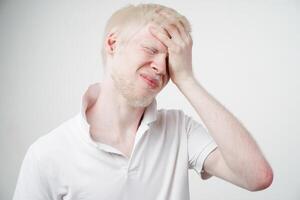 albinisme albinos homme dans studio habillé T-shirt isolé sur une blanc Contexte. anormal déviations. inhabituel apparence photo