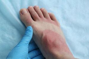 une médecin dans bleu gants fait du examine une rougeur femme jambe comme résultat de peau brûler. pied douleur après coup de soleil. dermatologie problèmes. inflammation sensible peau de allergiques. thermique brûler photo