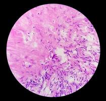 jambe tissu biopsie, photomicrographique image montrant fibromyxome. superficiel acral fibromyxome, rare lent croissance myxoïde tumeur photo