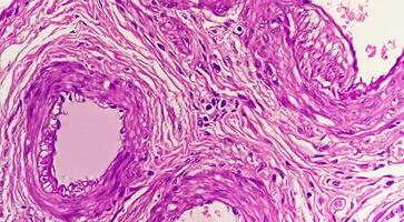 histologie, péritonéal inclusion kyste. paraovarien des kystes, hydrosalpinx et bas de gamme cystique mésothéliome sont d'habitude pris en considération dans le différentiel diagnostic de photos. photo