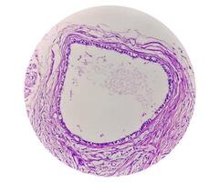 histologie, péritonéal inclusion kyste. paraovarien des kystes, hydrosalpinx et bas de gamme cystique mésothéliome sont d'habitude pris en considération dans le différentiel diagnostic de photos. photo