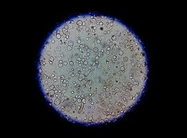 photomicrographie de analyse d'urine montrant beaucoup pus cellules, urinaire tract infection. photo