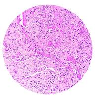 photomicrographie de histologique faire glisser montrant lobulaire capillaire hémangiome sur doigt. photo