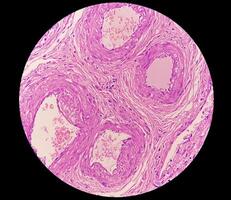 histologie, péritonéal inclusion kyste. paraovarien des kystes, hydrosalpinx et bas de gamme cystique mésothéliome sont d'habitude pris en considération dans le différentiel diagnostic de photos. photo