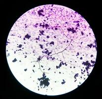 photomicrographie de Pap diffamer. inflammatoire diffamer avec vaginal candidose . médical concept. photo