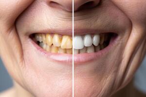 une fermer Comparaison de une Sénior femme sourire, avant et après les dents blanchiment photo