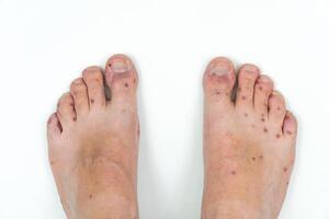 Humain jambes avec dermatite, allergie éruption cutanée. proche en haut de mâles pied et les orteils avec rouge téméraire maladie. entérovirus. coxsackie virus. allergique téméraire sur le jambes de un adulte homme photo