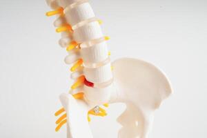 spinal nerf et os, lombaire colonne vertébrale déplacé hernie disque fragment, modèle pour traitement médical dans le orthopédique département. photo