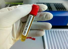 le biochimiste tient suffisamment de liquide céphalo-rachidien ou de csf pour un test de biochimie, y compris le glucose, les protéines, l'ada photo