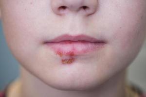 herpès sur les lèvres d'un garçon en gros plan photo
