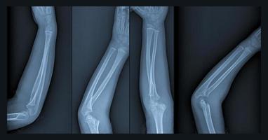radiographie bras cassé photo
