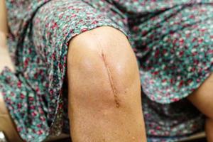 femme âgée asiatique patiente avec chirurgie de remplacement du genou cicatriciel à l'hôpital. photo