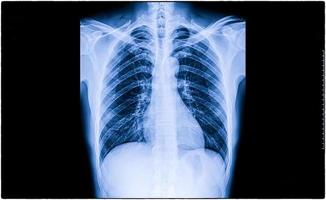 insuffisance cardiaque, film x-ray thorax pa debout montrer cardiomégalie et infiltrer interstitiel à la fois photo