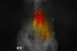 radiographie informatisée cr de la colonne vertébrale lombo-sarcale vue ap antéropostérieure montrant la spondylose et la scoliose de la colonne vertébrale photo