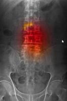 radiographie calculée cr de la colonne vertébrale lombo-sarcale antéropostérieure montrant une spondylose et une scoliose de la colonne vertébrale. photo