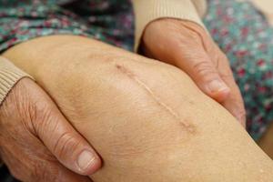 femme âgée asiatique patiente avec chirurgie de remplacement du genou cicatriciel à l'hôpital. photo