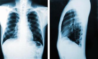 image radiographique, vue des hommes de la poitrine pour un diagnostic médical.