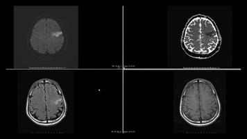images par résonance magnétique, irm, d'infarctus cérébral dans les coupes supérieures du lobe frontal gauche photo