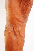 la gravité des varices varie des minuscules capillaires, des douleurs dans les jambes, des pieds et des jambes enflés, et l'anévrisme tordu ressemble à un ver. photo