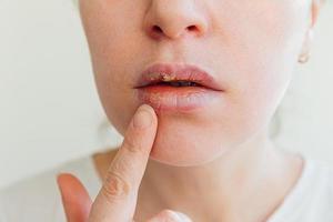 gros plan sur les lèvres de la fille affectées par l'herpès. traitement de l'infection et du virus de l'herpès. partie du visage de la jeune femme avec le doigt touchant la douleur sur les lèvres avec l'herpès affecté. concept de dermatologie de beauté. photo