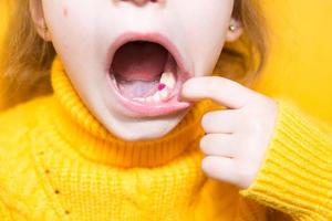 remplissage violet coloré sur la dent de mastication de lait de la fille. dentisterie pédiatrique, traitement et examen. un enfant avec une bouche ouverte montre une dent en gros plan sur un fond jaune. photo