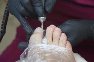 pédicure médicale matérielle. podologie. correction de la forme de l'ongle du pied, pose d'une agrafe en titane, fils. patient subissant un traitement de pédicure par un podiatre. photo