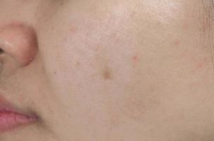 tache d'acné sur la peau du visage d'une femme asiatique. concept avant le traitement au laser du visage pour se débarrasser des taches brunes post-acné. photo