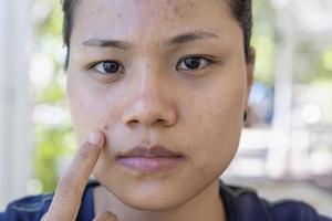 une jeune femme asiatique s'inquiète pour son visage lorsqu'elle a des problèmes de peau sur son visage dans un contexte naturel. problèmes d'acné et de cicatrice sur la peau féminine. problème de soins de la peau et concept de santé. photo