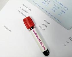 échantillon de sang pour test alt, ast et bilirubine totale avec rapport anormal. lfts ou tests de la fonction hépatique. photo