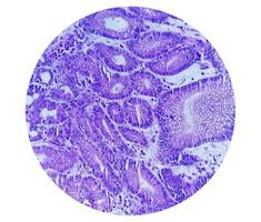 photomicrographie ou image microscopique du cancer de l'estomac. adénocarcinome de l'estomac photo