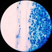 leucocyte bleu dans un échantillon d'aspiration d'articulation du genou.