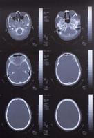 Libre d'un scan CT avec cerveau