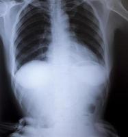 radiographie de la poitrine humaine pour un diagnostic médical photo