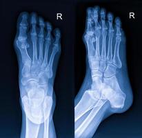 radiographie du pied