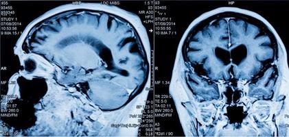 scan de la tête IRM