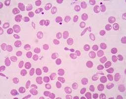 thalassémie à frottis sanguin montrant hypochromie, schistocytes, nrc, targ photo
