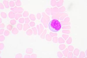 lymphocytes réactifs photo
