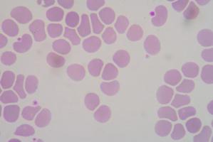 les globules rouges forment la macrocytose. photo