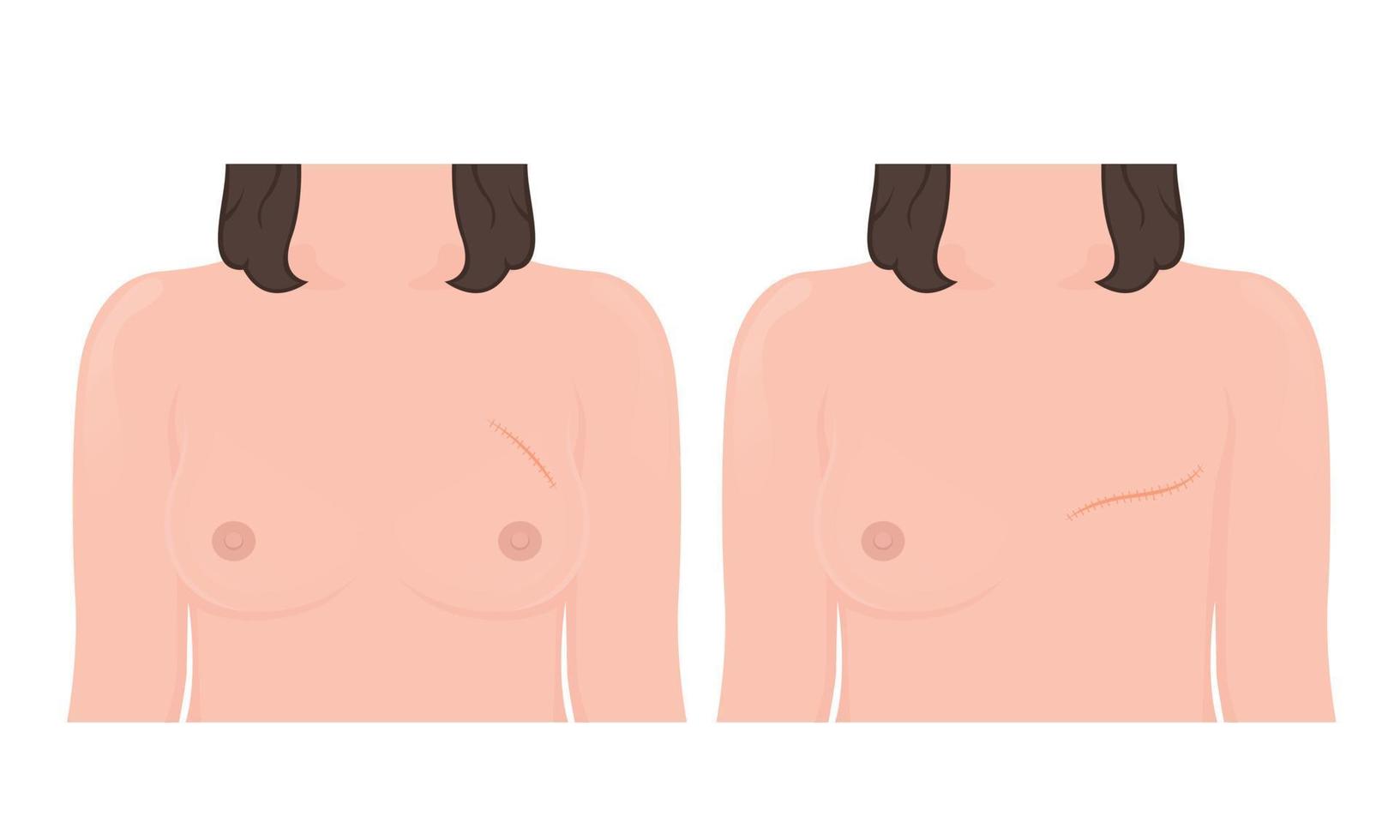 mastectomie cancer du sein chirurgie des ganglions lymphatiques vecteur