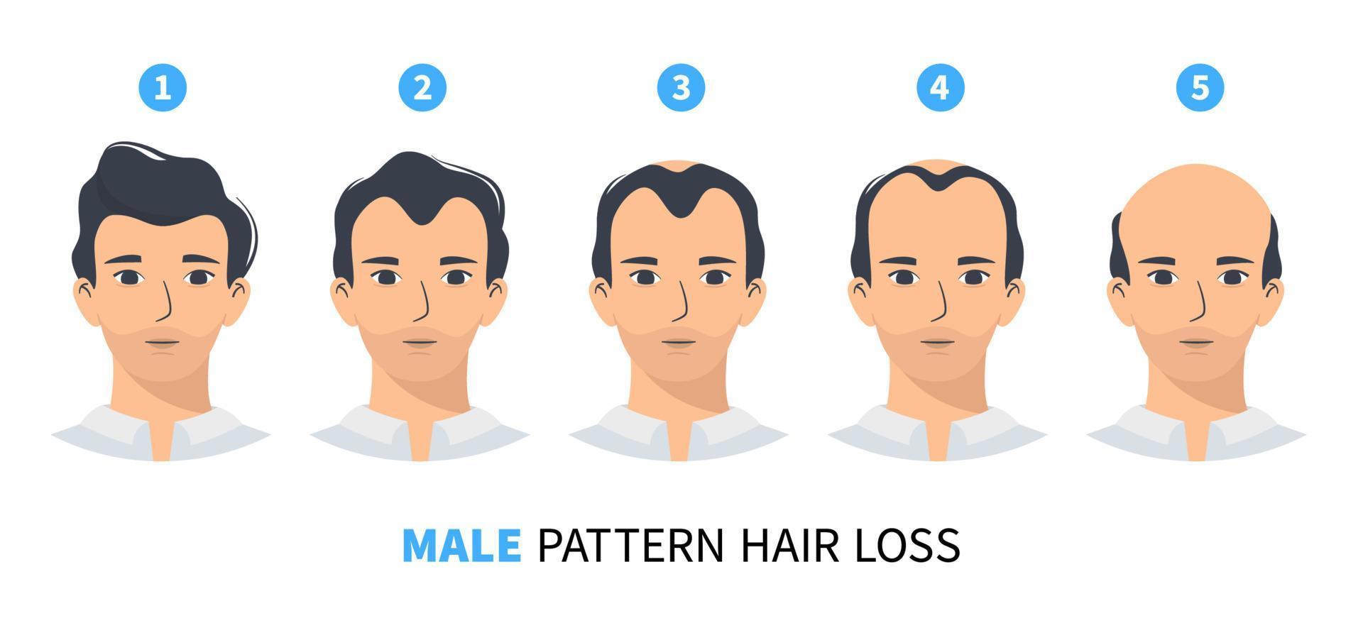 stades de perte de cheveux, modèle masculin d'alopécie androgénétique. étapes de l'infographie vectorielle de la calvitie dans un style plat avec un homme. mi/h vecteur