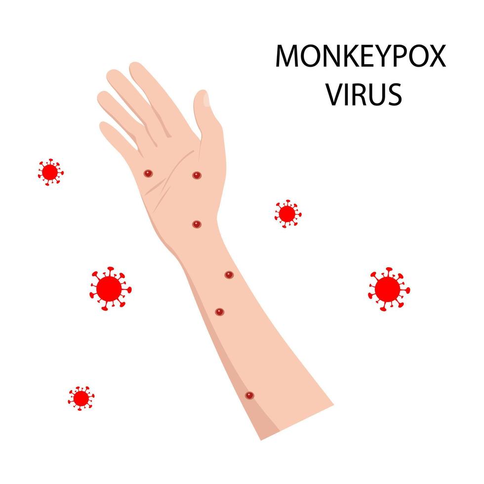 symptôme de monkeypox sur le corps humain. variole du singe. illustration vectorielle vecteur