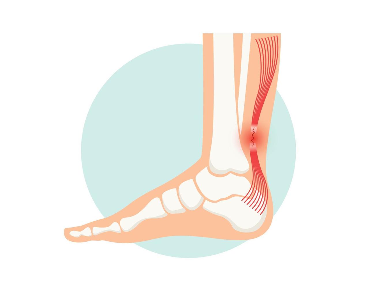 affiche anatomique de rupture du tendon d'achille. blessure à la cheville, entorse ligamentaire et problèmes de déchirure vecteur