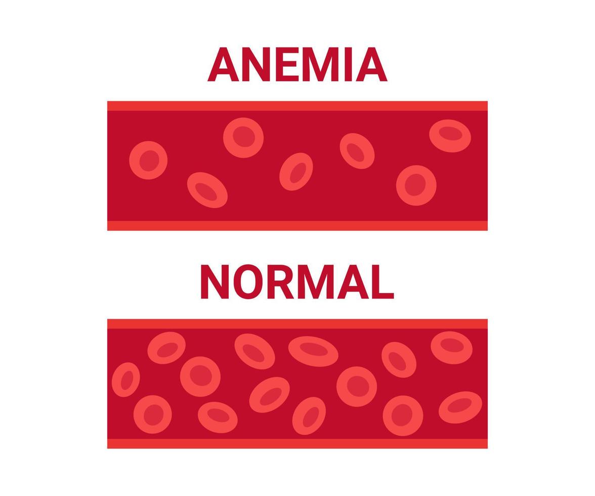 sang normal et anémique dans la comparaison des vaisseaux, nombre de cellules de circulation érythrocytes. faible taux d'hémoglobine, anémie ferriprive. cellules sanguines anémiques de la maladie. problème de santé. illustration vectorielle vecteur