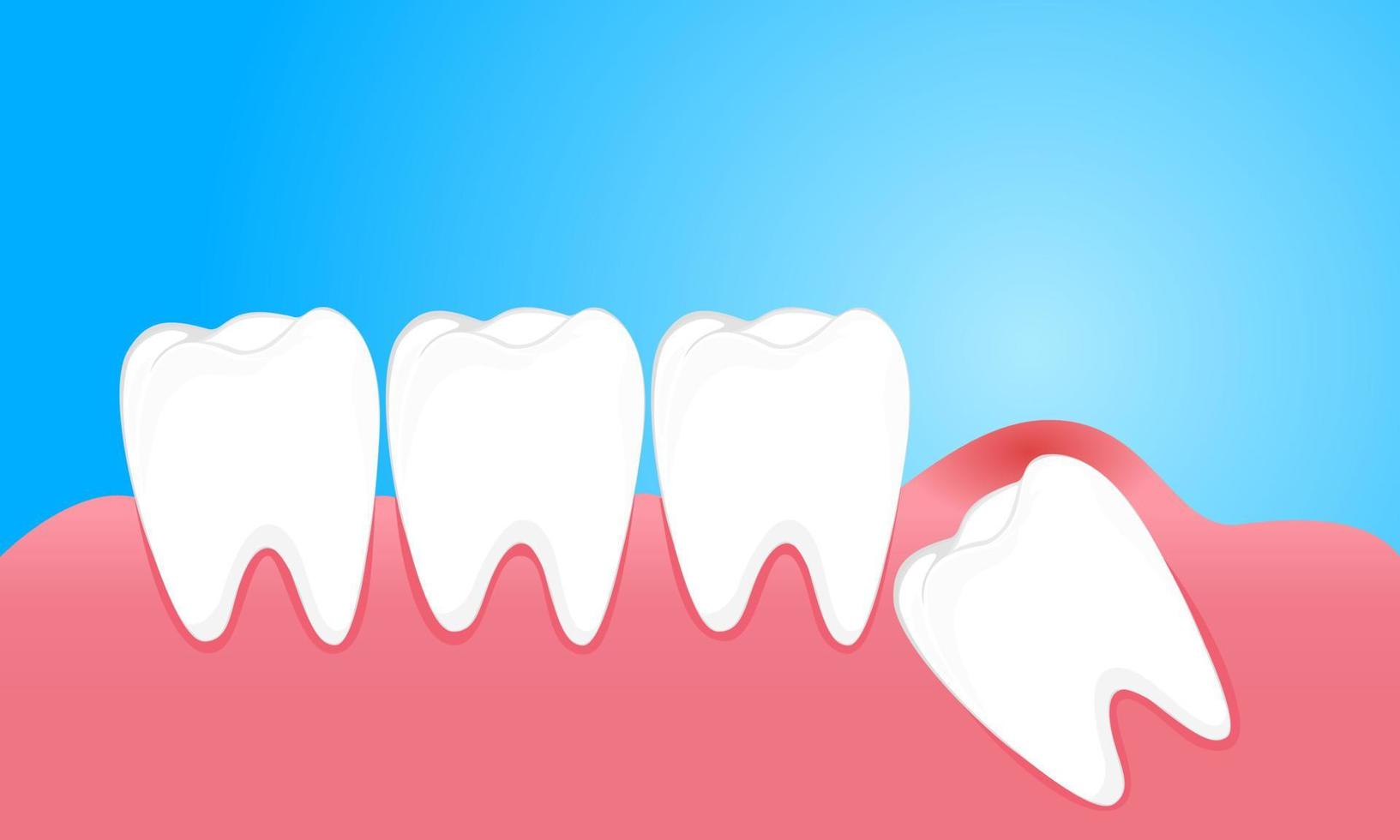 les dents de sagesse causent des douleurs aux gencives vecteur