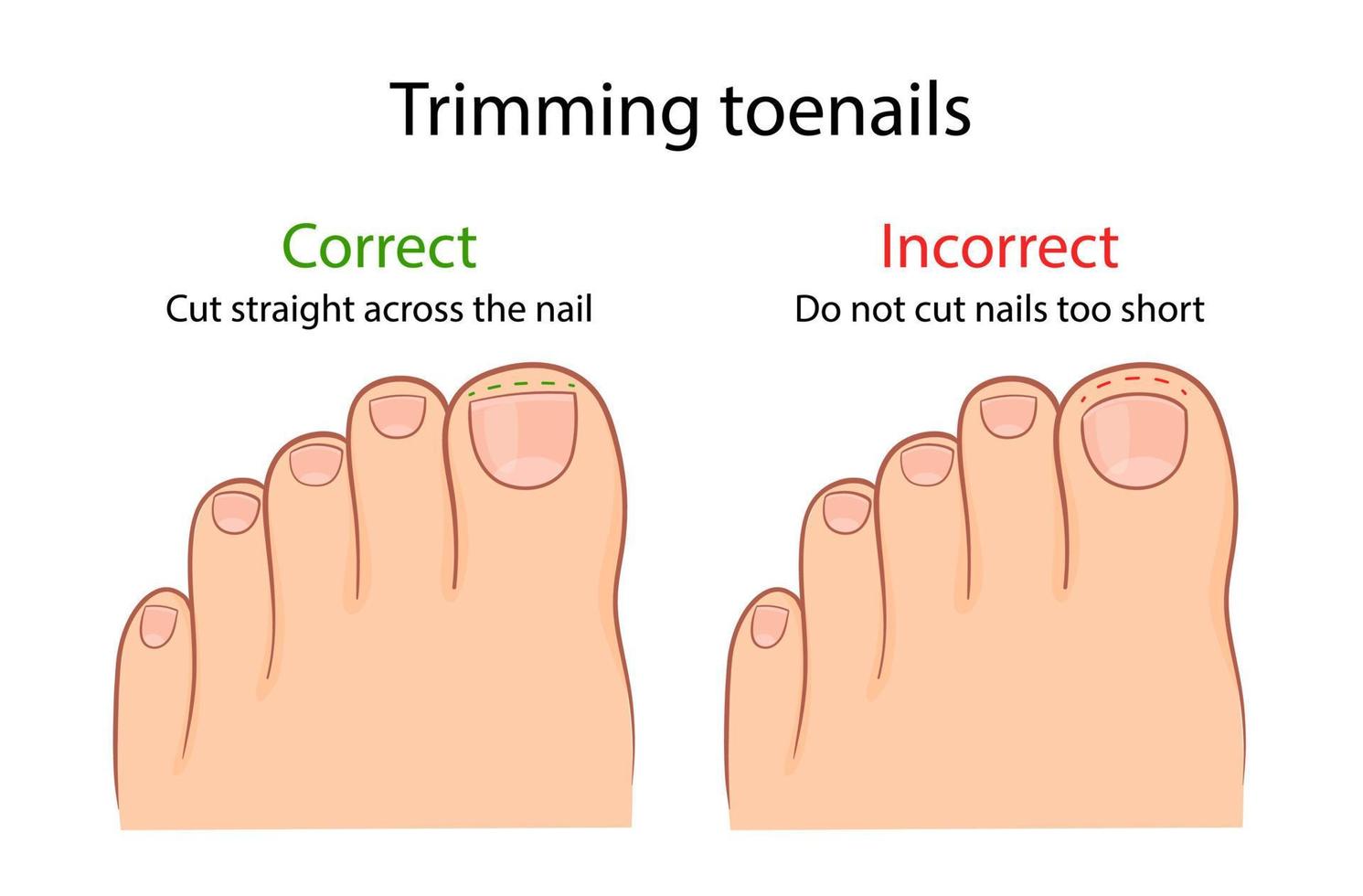 coupe correcte et incorrecte de l'ongle du pied. illustration médicale vecteur